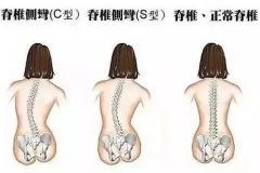 孩子脊椎變形的原因您知道多少？